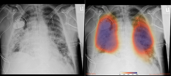 Chest X-rays from a patient with COVID-19 pneumonia, original x-ray (left) and AI-for-pneumonia result (right). Patient has a pacemaker device and an enlarged heart, which indicates that the AI algorithm is powerful enough to work even when the patient has underlying health issues.